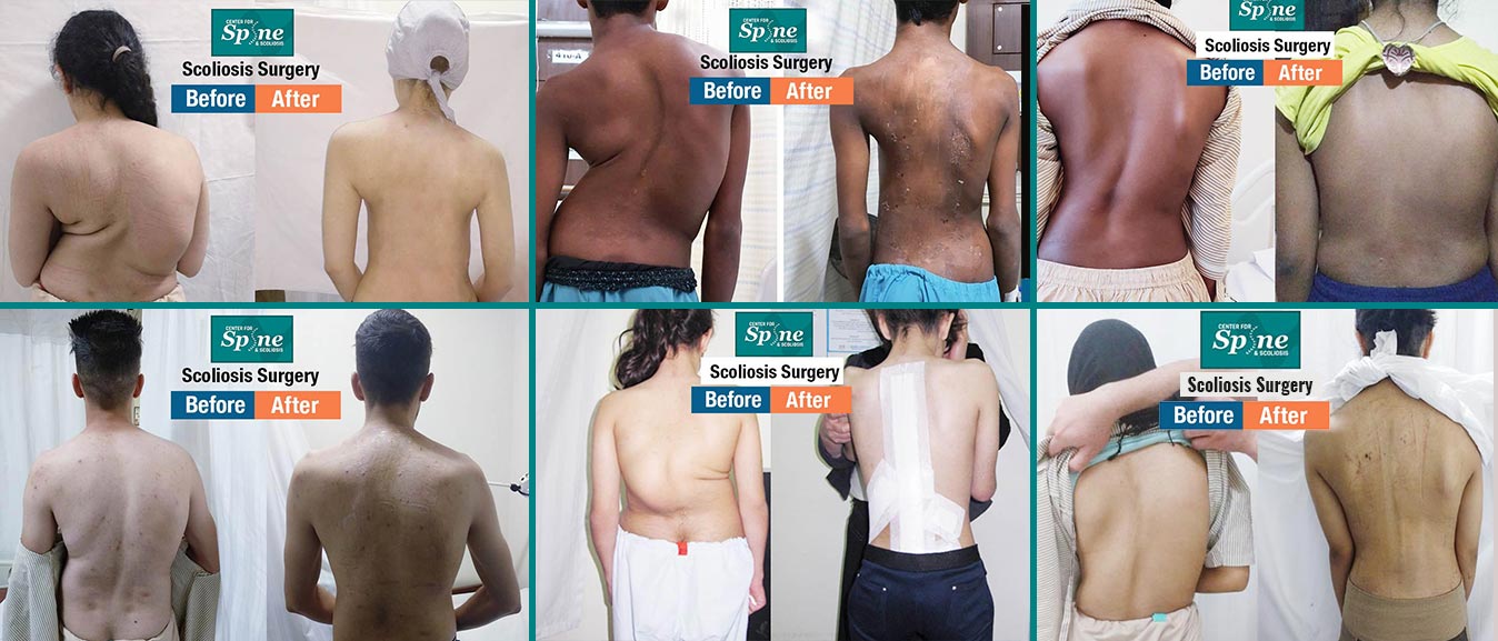 scoliosis correction surgery results