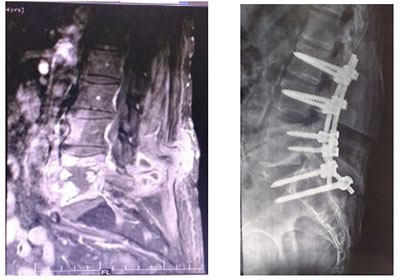 Spinal Infections Treatment