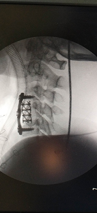 Cervical Spine Surgery