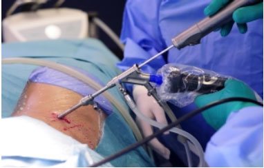 Microendoscopic disectomy