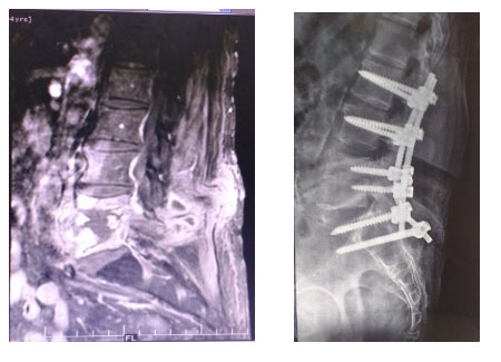 spinal infections