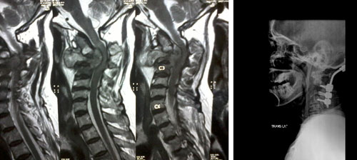 Tubercular Spinal Infection