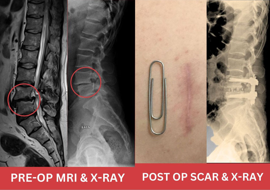 Spondylolisthesis Condition After Successful OLIF Surgery in India