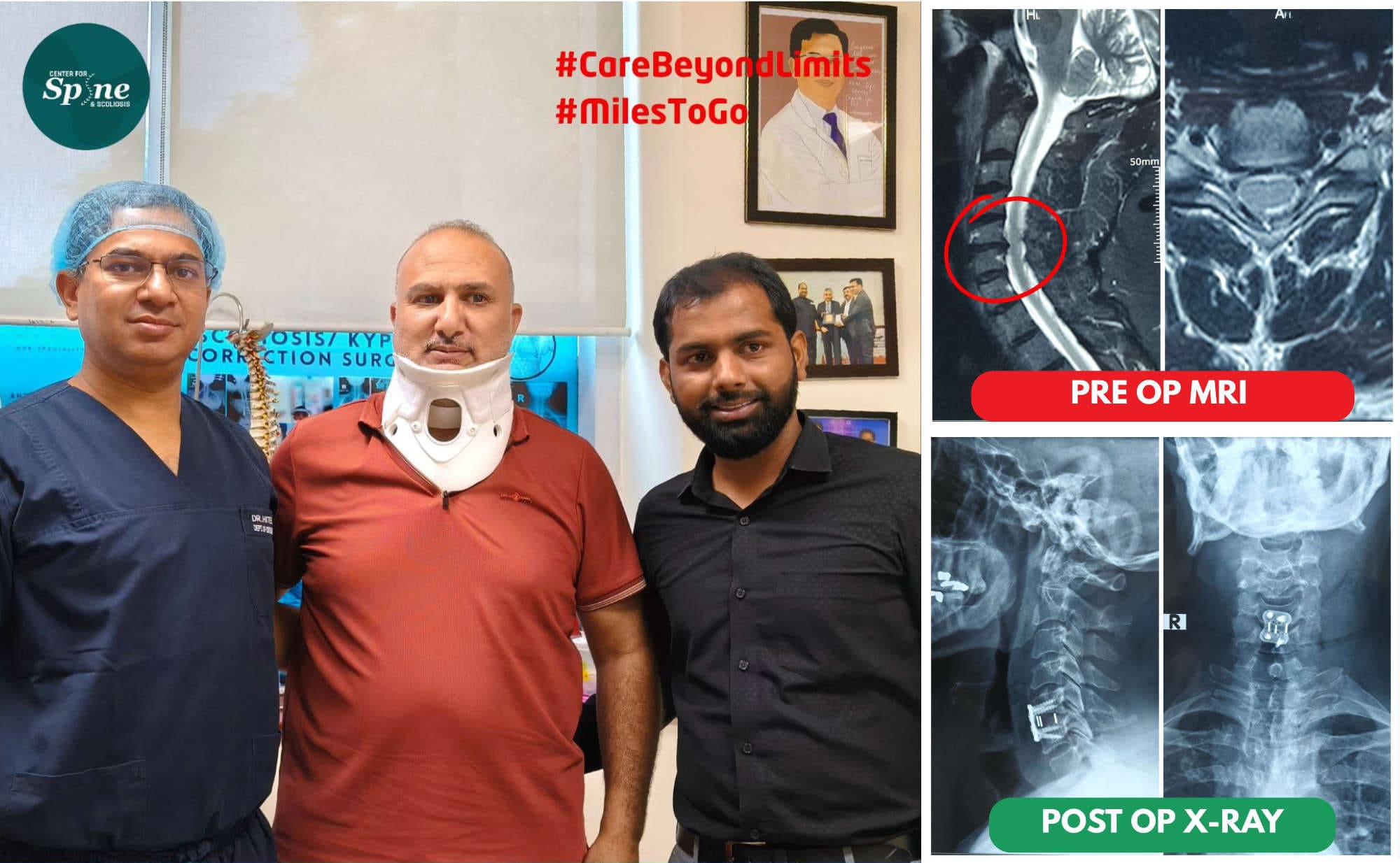ACDF Surgery in India