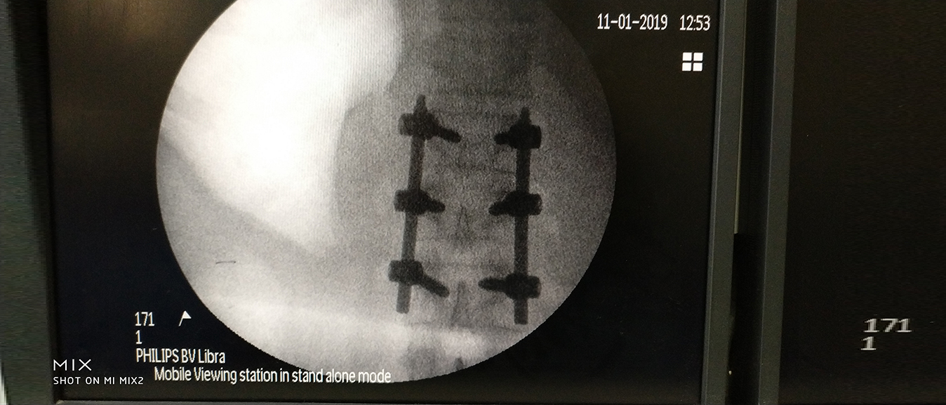 Spinal Fracture Fixation