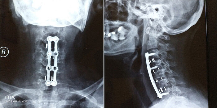 Four Level ACDF - Cervical Spine Surgery