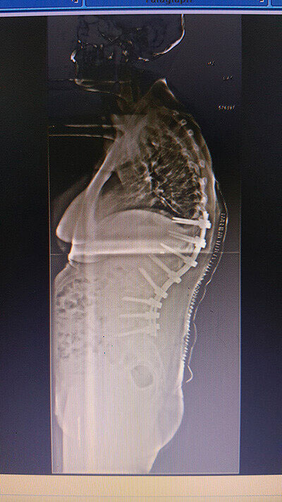 Ankylosing Spondylitis - Spine Surgery