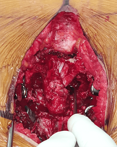 GCT Sacral Tumor - Spinal Tumor Surgery