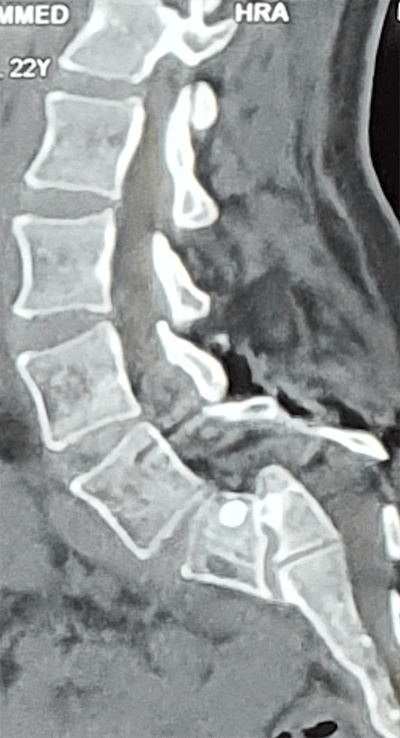 Spondyloptosis - Spine Surgery