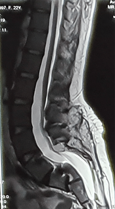 Spondyloptosis Rasha