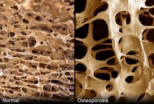 Osteoporosis Treatment