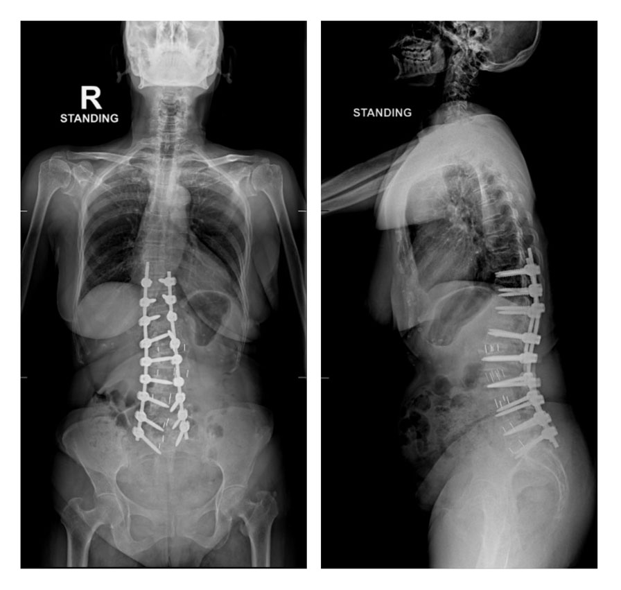 Case Study for A 66-Year-Old Lady’s Degenerative Lumbar Scoliosis Surgery: A Successful Treatment Journey