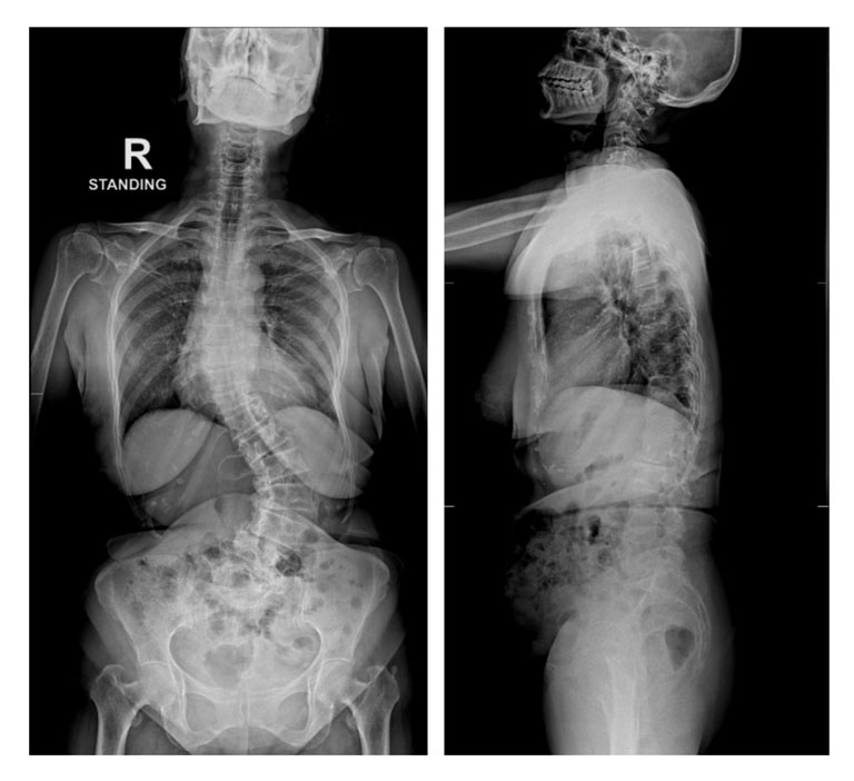 Degenerative Lumbar Scoliosis