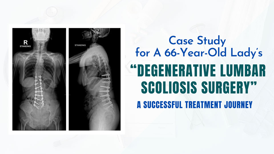 Case Study for A 66-Year-Old Lady’s Degenerative Lumbar Scoliosis Surgery