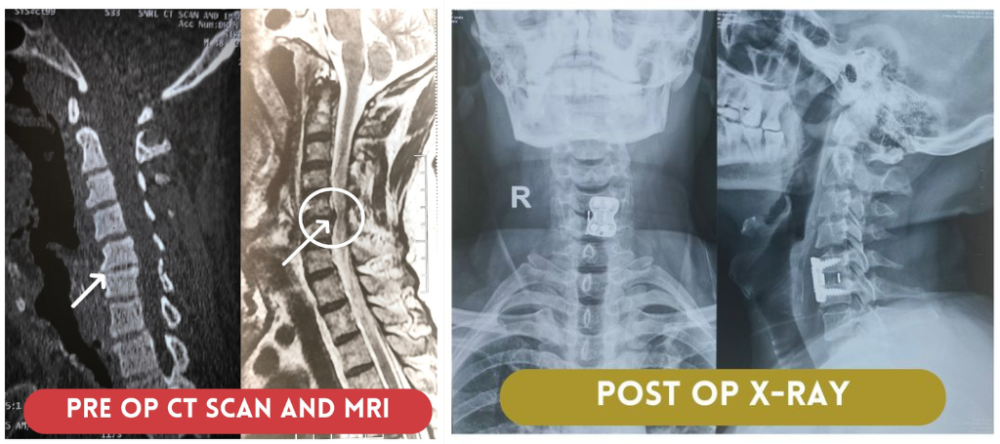A Medical Emergency: Successful Spine Surgery of 47 year old Man