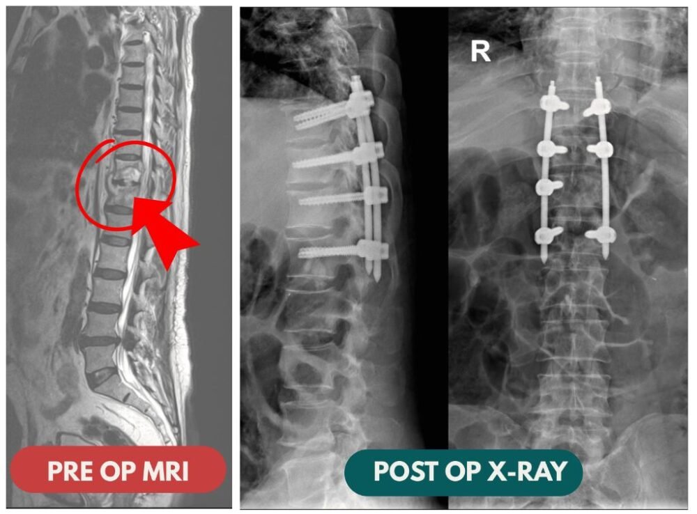 Spondylodiscitis to Recovery in India