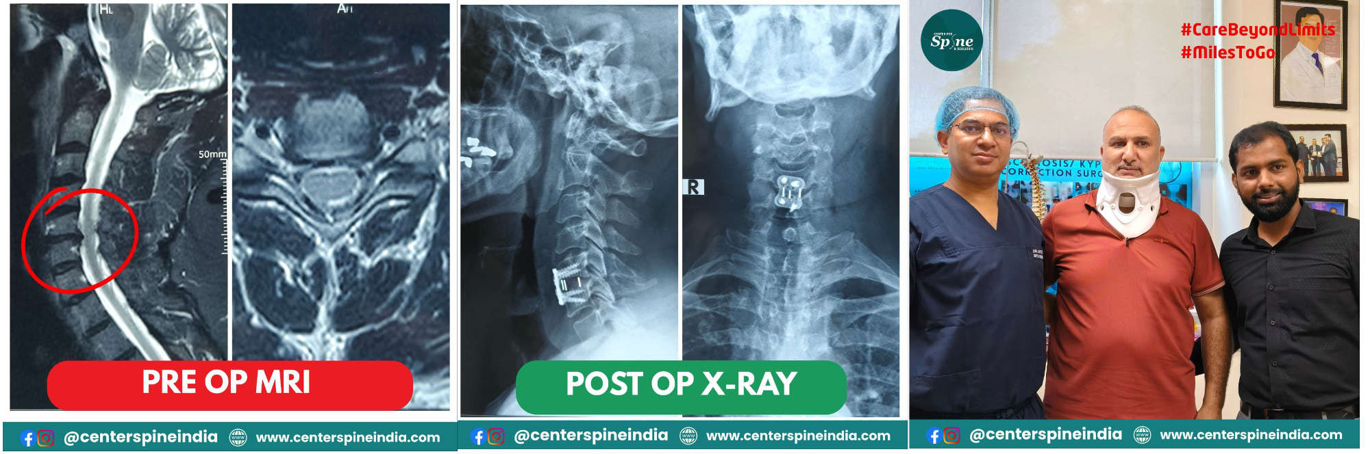 ACDF Surgery in India