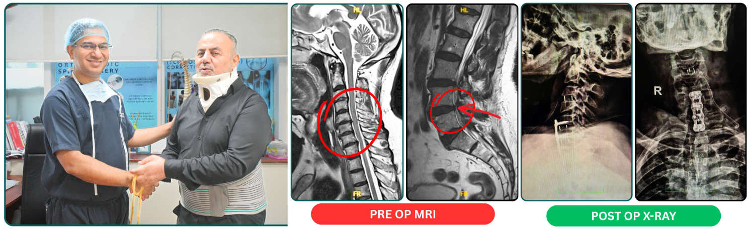 Successful Spine Surgery in India