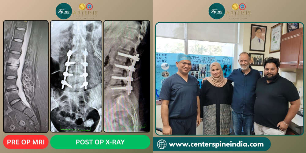 Lumbar Spondylodiscitis surgery in India