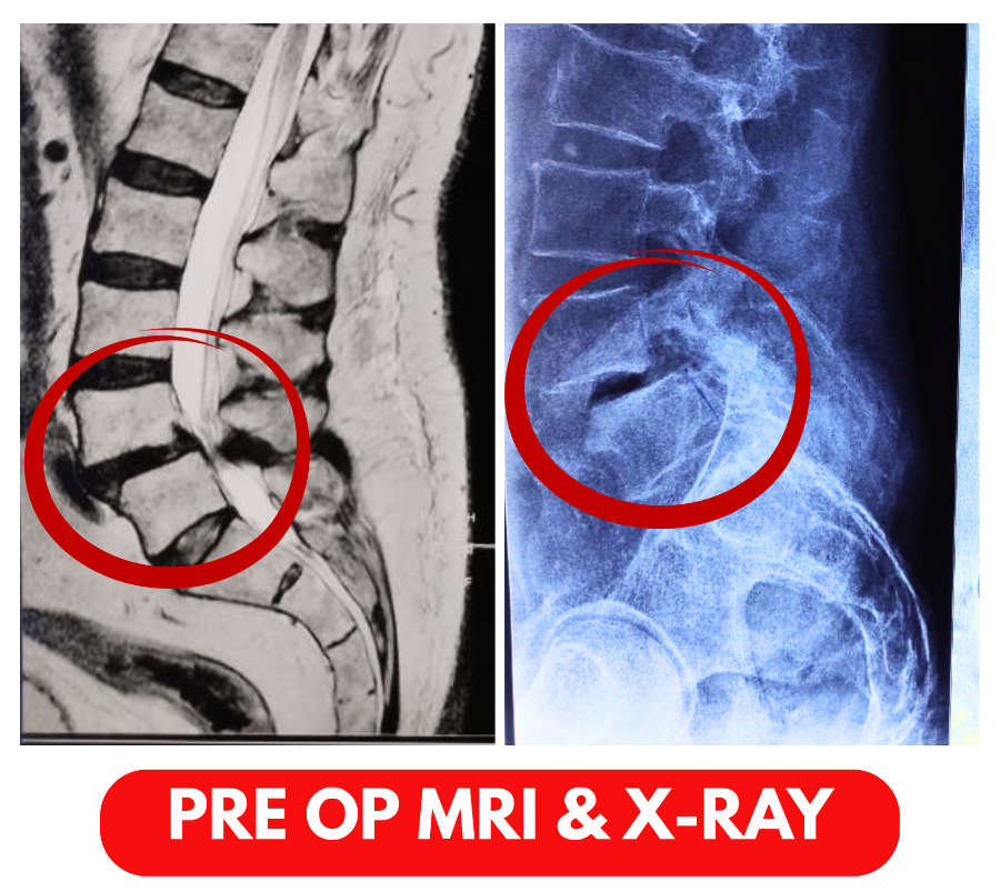 Transforaminal Lumbar Interbody Fusion (TLIF) Surgery Pre OP X-Ray