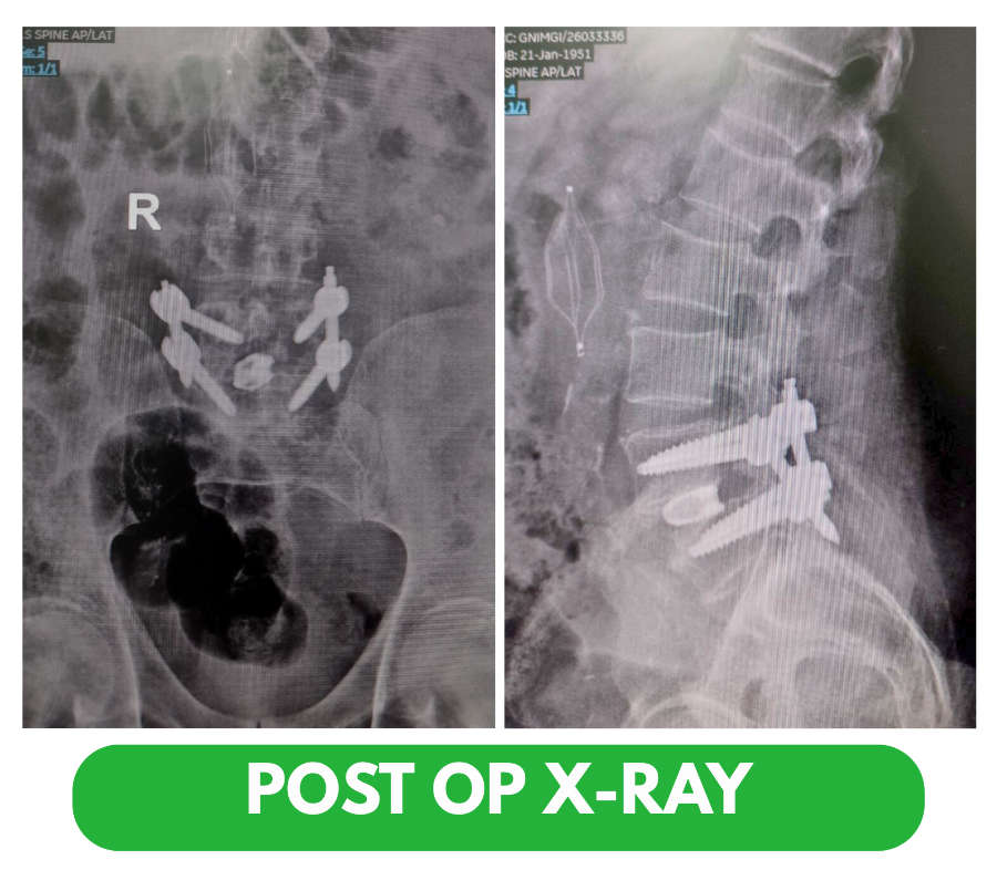 Transforaminal Lumbar Interbody Fusion (TLIF) Surgery post OP X-Ray