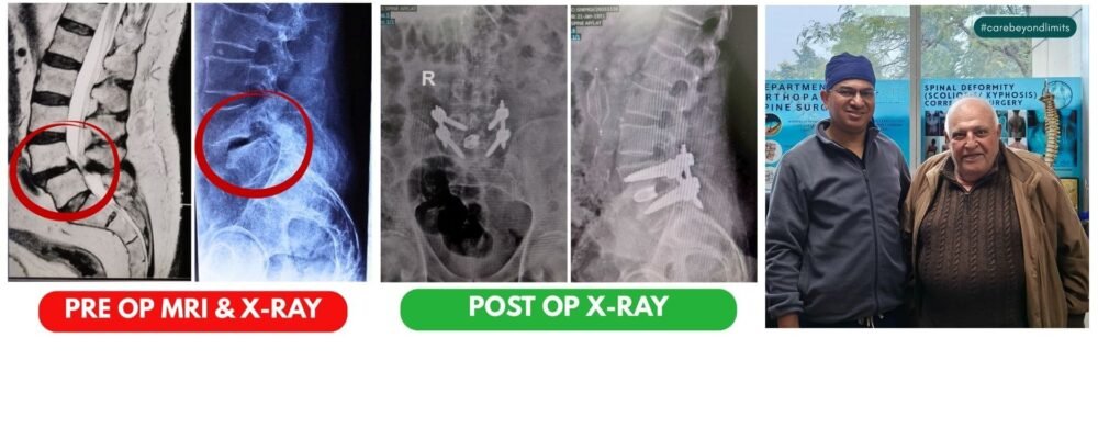 Successful MIS-TLIF Spine Surgery in India