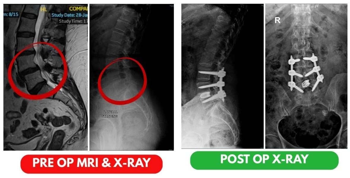 Successful Minimally Invasive Spine Surgery