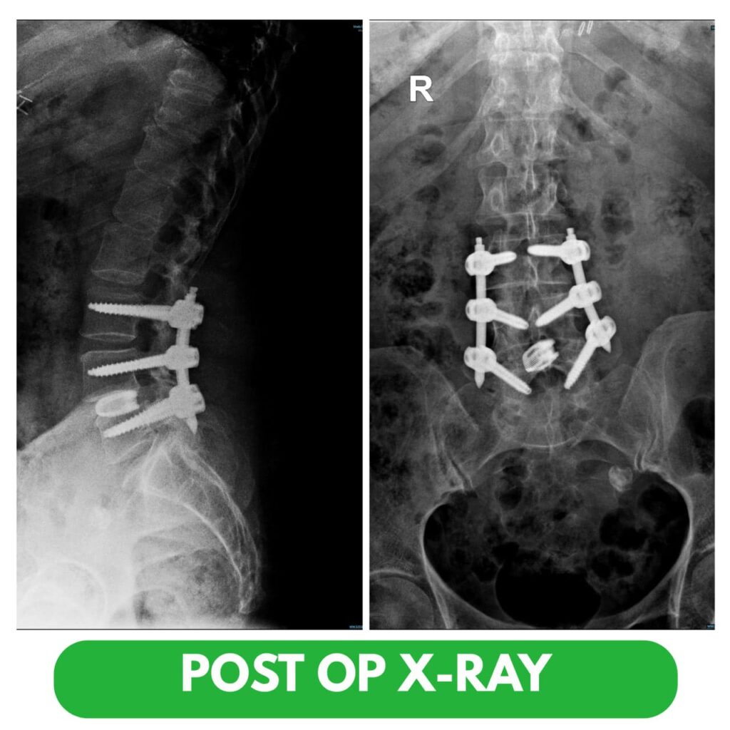 L3–L5 Minimally Invasive Fixation with L4–L5 Transforaminal Lumbar Interbody Fusion (TLIF)