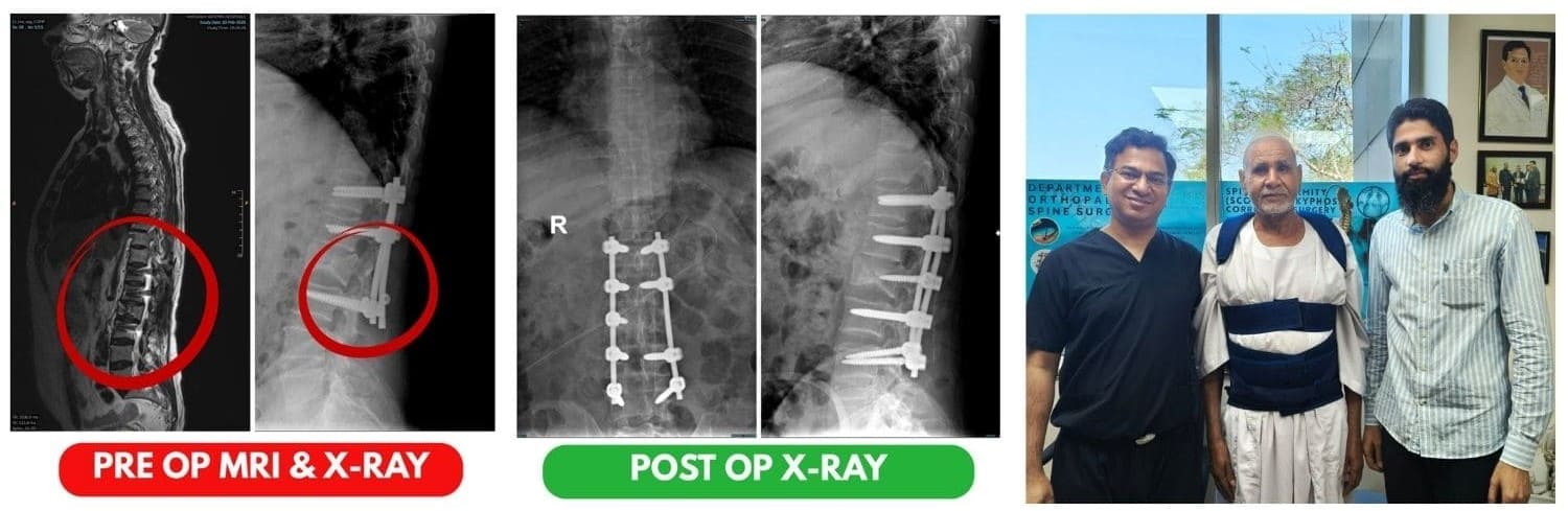 Successful Revision Spine Surgery in India